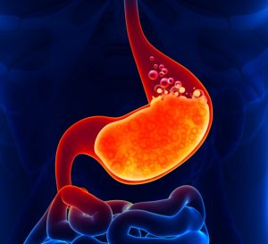 Gastroesophageal reflux disease demonstration