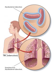 Diagram of Tuberculosis in lungs