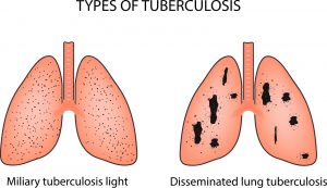 Diagram of Latent TB infection and TB disease