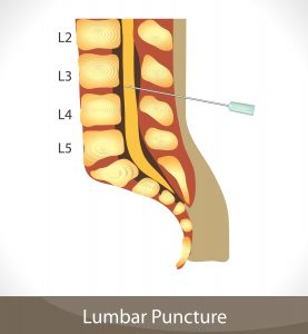 Lumbar Puncture diagram