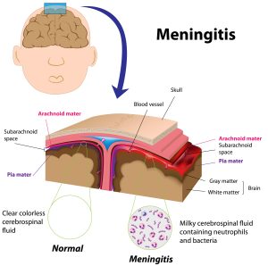 Diagram of Meningitis