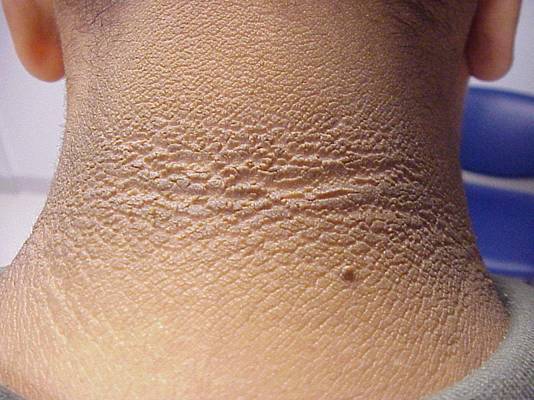 Are You at Risk/Acanthosis Back of Neck 2