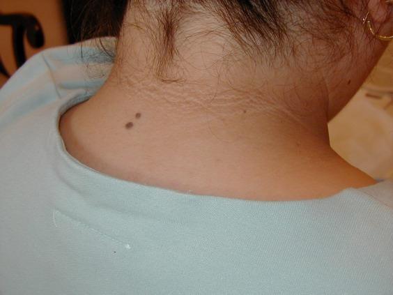 Are You at Risk/Acanthosis Back of Neck 7